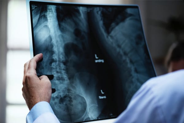 Cauzele tumorilor maduvei spinarii si tratament