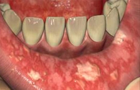 mucozita orala simptome
