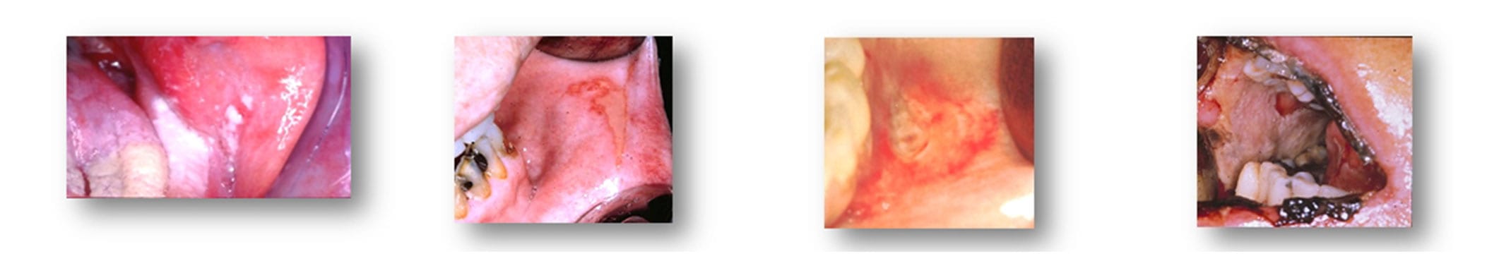 mucozita orala simptome
