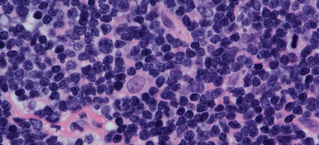 Limfom difuz cu celule mari: cauze, simptome și tratament