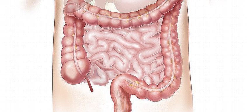 cancerul de colon primele simptome îndepărtarea medicamentului de negi genitale