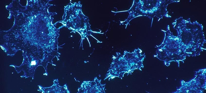 Ce sunt celulele canceroase si cum se raspandeste cancerul in organism