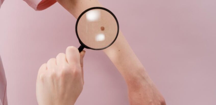 factori de risc pentru cancerul de piele